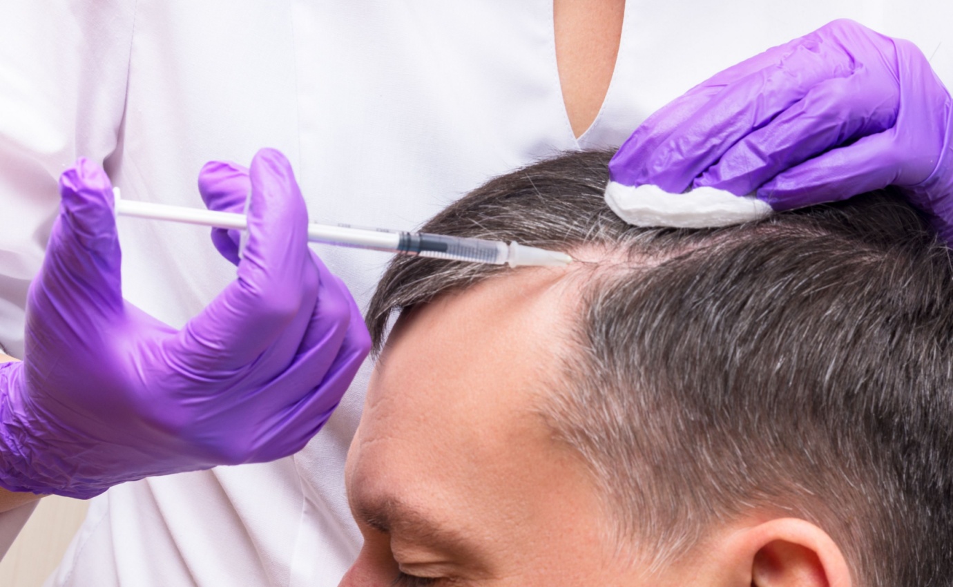 Ein Mann erhält eine PRP-Behandlung gegen Haarausfall. PRP, das aus dem eigenen Blut gewonnen wird, verspricht die Regeneration von Haarfollikeln und die Förderung des Haarwachstums. Diese innovative Therapie wird zunehmend bei der Behandlung von Haarausfall eingesetzt.