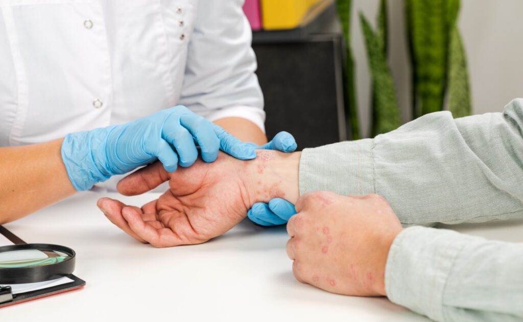 Ein Arzt untersucht die Hautausschläge eines Patienten am Handgelenk. Die Ozontherapie bietet effektive Behandlungsmöglichkeiten für Hauterkrankungen wie Ekzeme und Psoriasis.