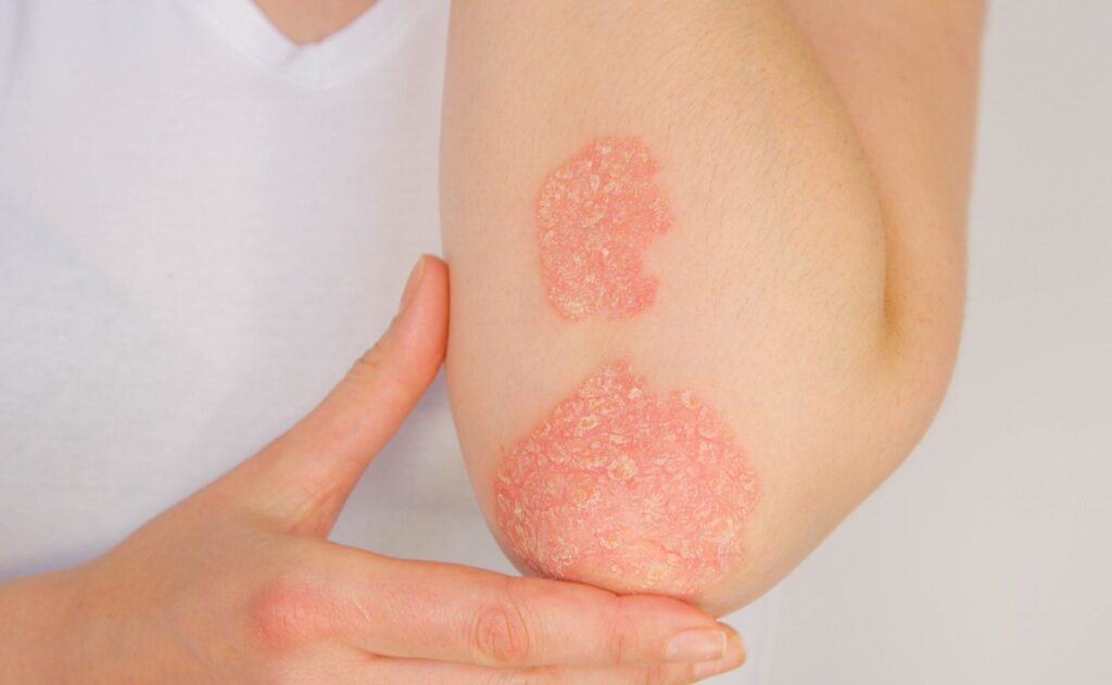 Nahaufnahme von Psoriasis-Plaques auf der Haut eines Patienten, die deutlich gerötete und schuppende Bereiche aufweisen, typische Symptome der Psoriasis-Arthritis.