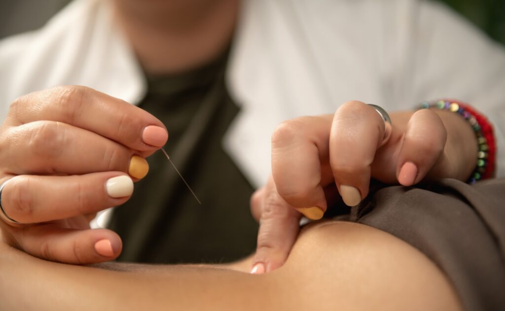 Nahaufnahme einer Akupunkturbehandlung bei chronischen Ischiasschmerzen – eine neue Studie zeigt deutliche Wirkung